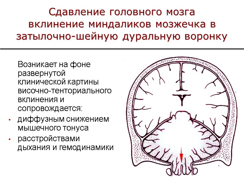 Сдавление головного мозга вклинение миндаликов мозжечка в затылочно-шейную дуральную воронку  Возникает на фоне